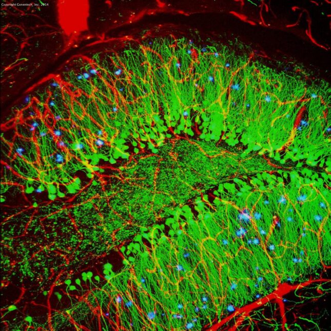 Brain showing Alzheimer’s