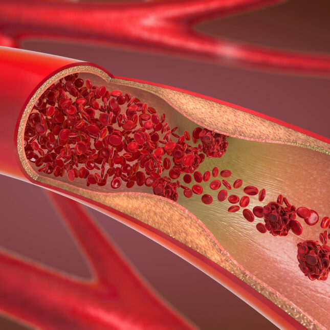 Blood cells flow through an artery as the vessel wall grow thick — coverage from STAT