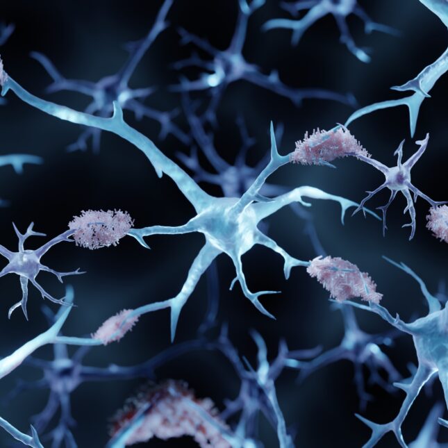 Amyloid plaques aggregates on neurons in Alzheimer's disease — first opinion coverage from STAT