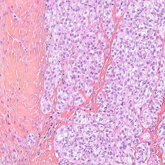 Clear cell sarcoma, in pink, was revealed in a tendon, shown in purple, under a micrograph